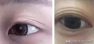 割了双眼皮还可以做微整形吗,割双眼皮是整容还是医美
