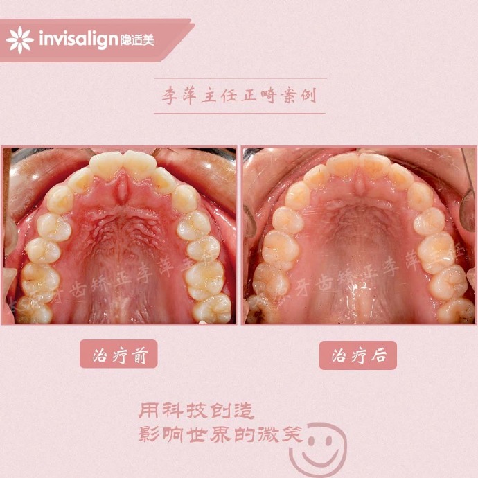 龅牙矫正牙齿能解决下颌后缩么,儿童正畸能解决鼻基底凹陷问题吗