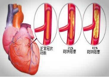 支架术后五年后气短咋办,胆管支架术后疼痛几天能消失