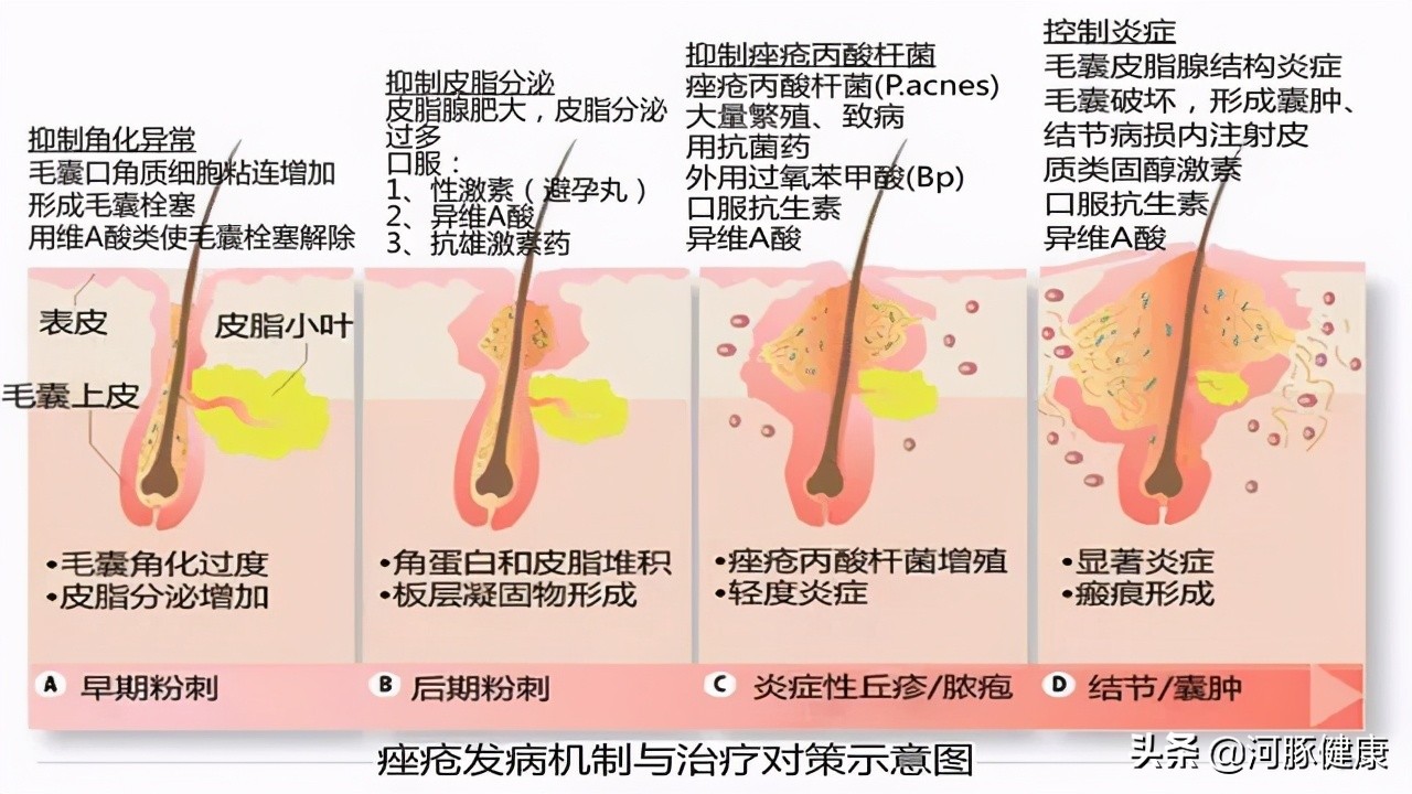 被*疮痤**遮盖了颜值？来聊聊*疮痤**的常用药物吧？