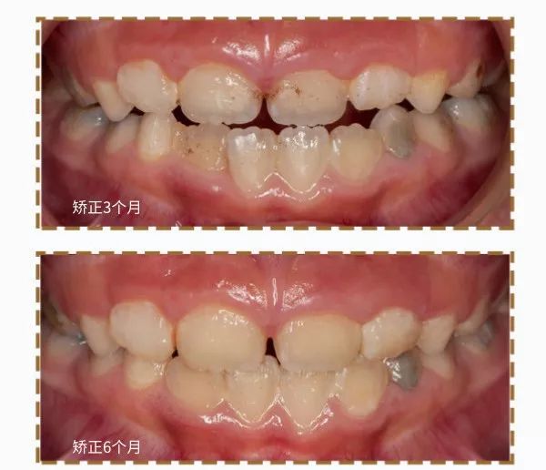 站到台上的“放大镜”女孩，门牙不整齐怎么办？