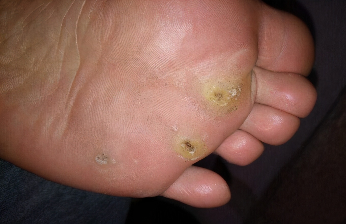 脚上长了病毒疣最简单的去除方法,脚病毒疣