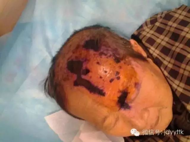 有一种剧痛叫带状疱疹,肋间神经痛与带状疱疹哪个比较痛