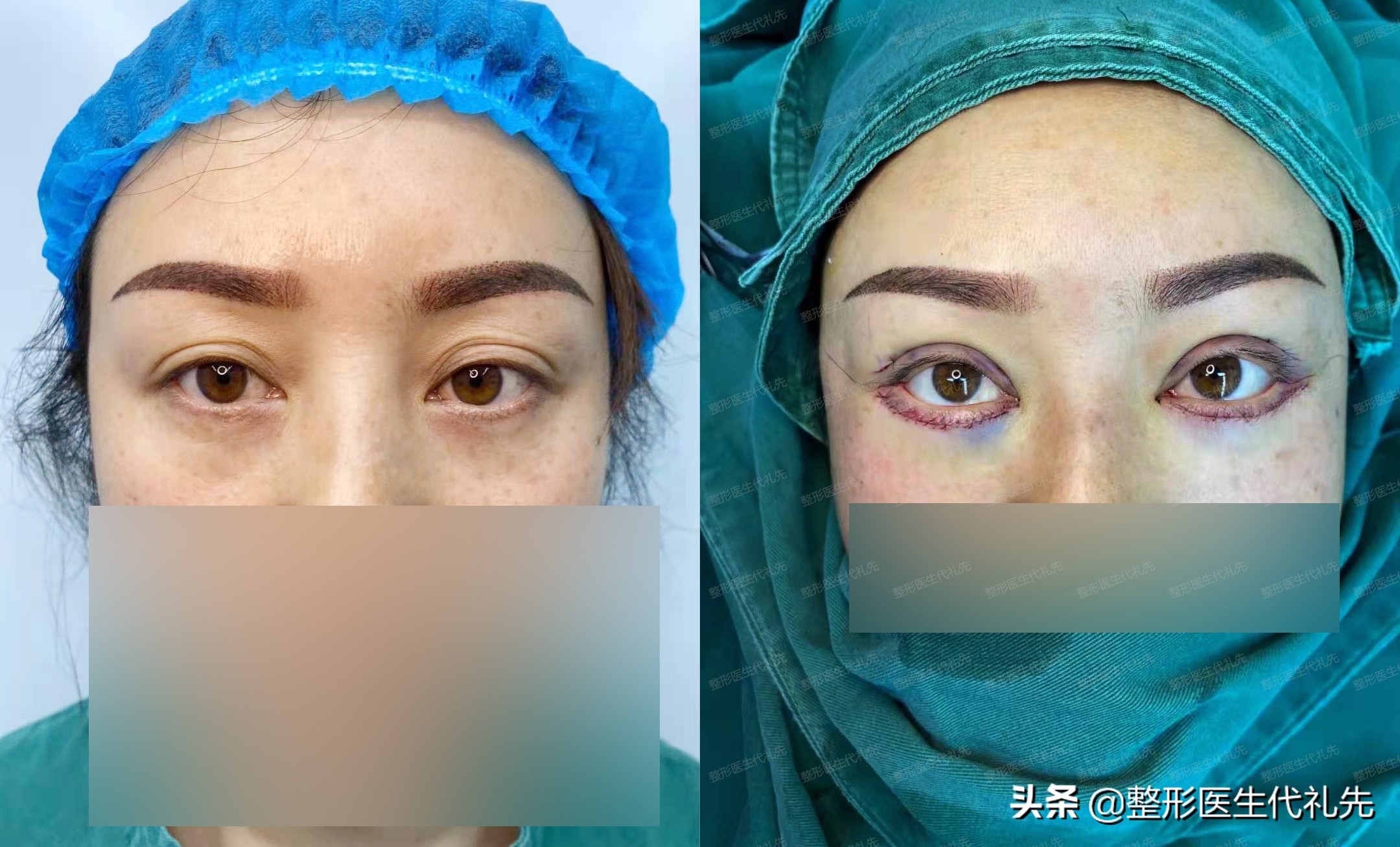 眼细纹和眼纹,眼部衰老导致眼纹