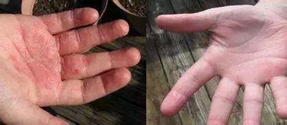 我亲身经历的中老年皮肤瘙痒、湿疹治疗故事