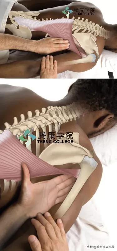 背阔肌综合征病历,背阔综合症