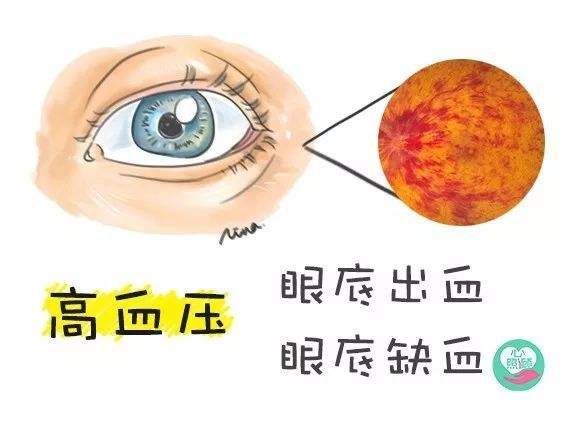 眼睛干涩容易疲劳吃什么药,眼睛干涩喝什么茶养肝明目