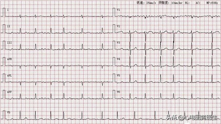 心电图分析为室性心律,房室性心动过速心电图图片