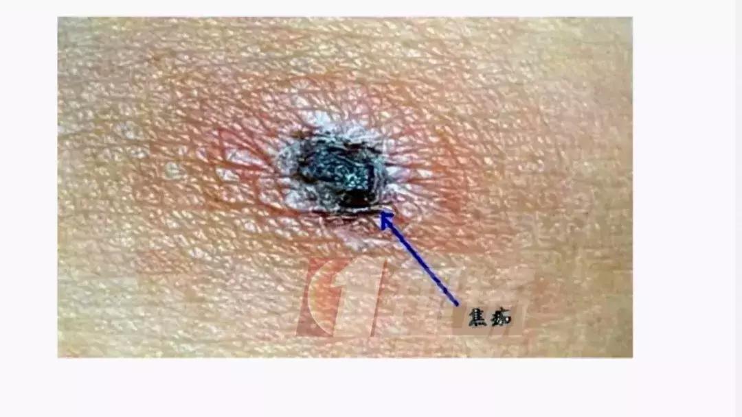 儿童被不明虫子咬了肿一大块止痒,小朋友被虫子咬了的危险视频
