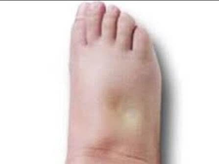 怀孕水肿很厉害休息后也不减轻,孕期水肿怎么消肿最快最有效果