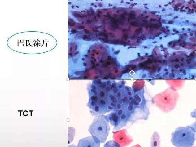 hpv核酸检测和e6e7检测有什么区别,hpv筛查和e6e7筛查有什么区别