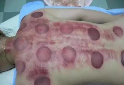 为何拔罐肩膀处罐印最深,拔罐没有罐印代表什么意思