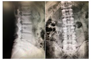 五分钟带你走进脊柱放射检查