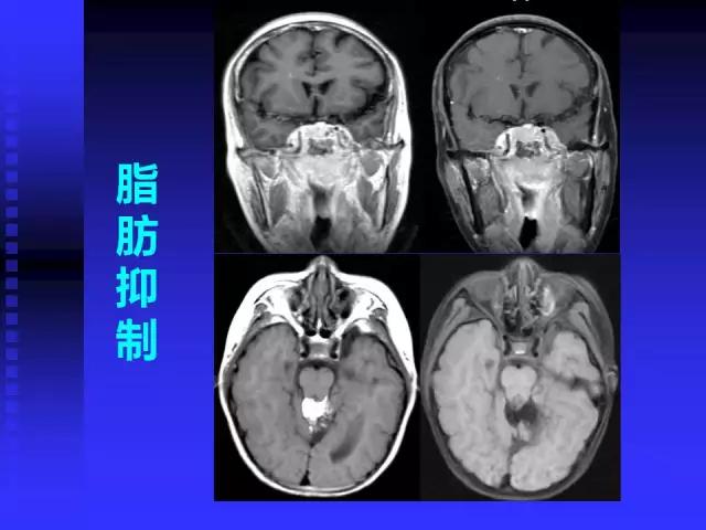 头颅mri读片视频教程,颅脑mri读片入门教程视频讲解全集