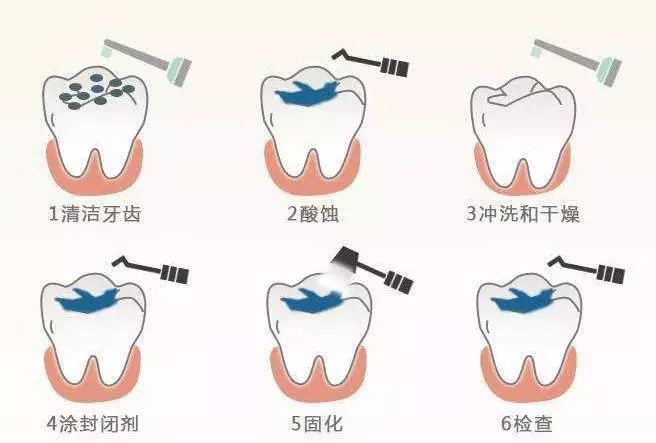 认真刷牙、不吃糖的娃竟得了10颗蛀牙，只因家长疏忽了这4点