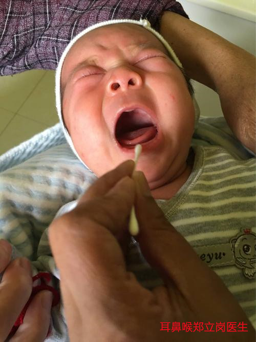 鱼骨卡喉咙久了会化掉吗,喉咙卡到鱼骨怎么解决