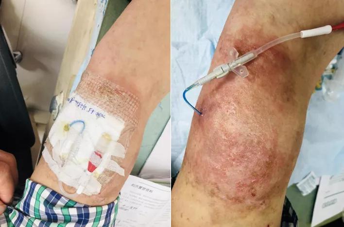 picc置管敷贴皮肤痒如何处理,picc置管防过敏贴膜进口