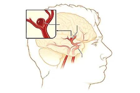 心血管病人眼睛肿怎么回事,心血管疾病引起眼皮水肿严重吗