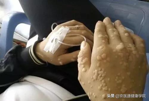 粟丘疹汗管瘤扁平疣区别,粟丘疹和汗管瘤区别