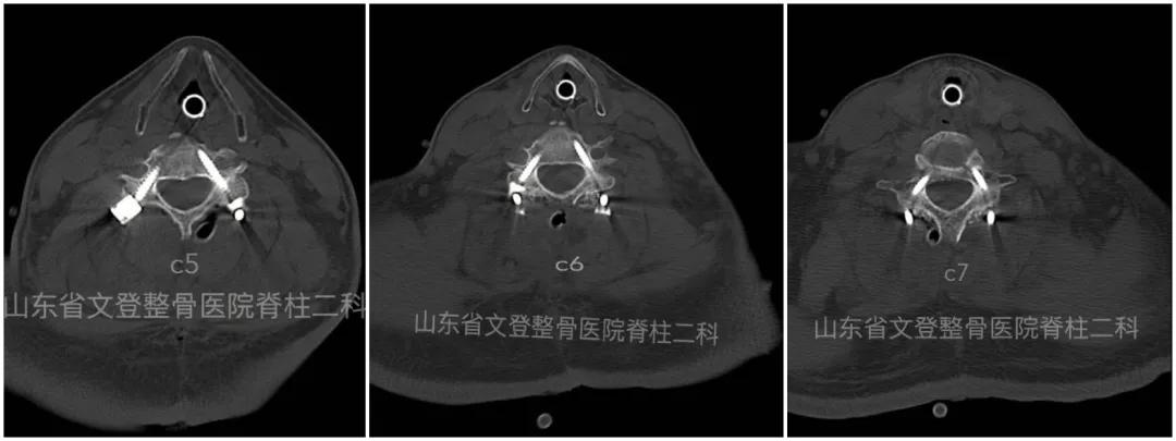 文登整骨医院治疗截瘫,山东文登整骨医院治疗怎么样