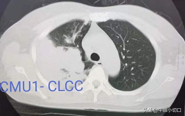 胸腔长了个小瘤子怎么办,胸腔长瘤该怎么办