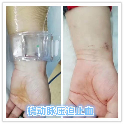 囊性子宫腺肌病的特点是什么,囊性腺肌病最佳治疗方案