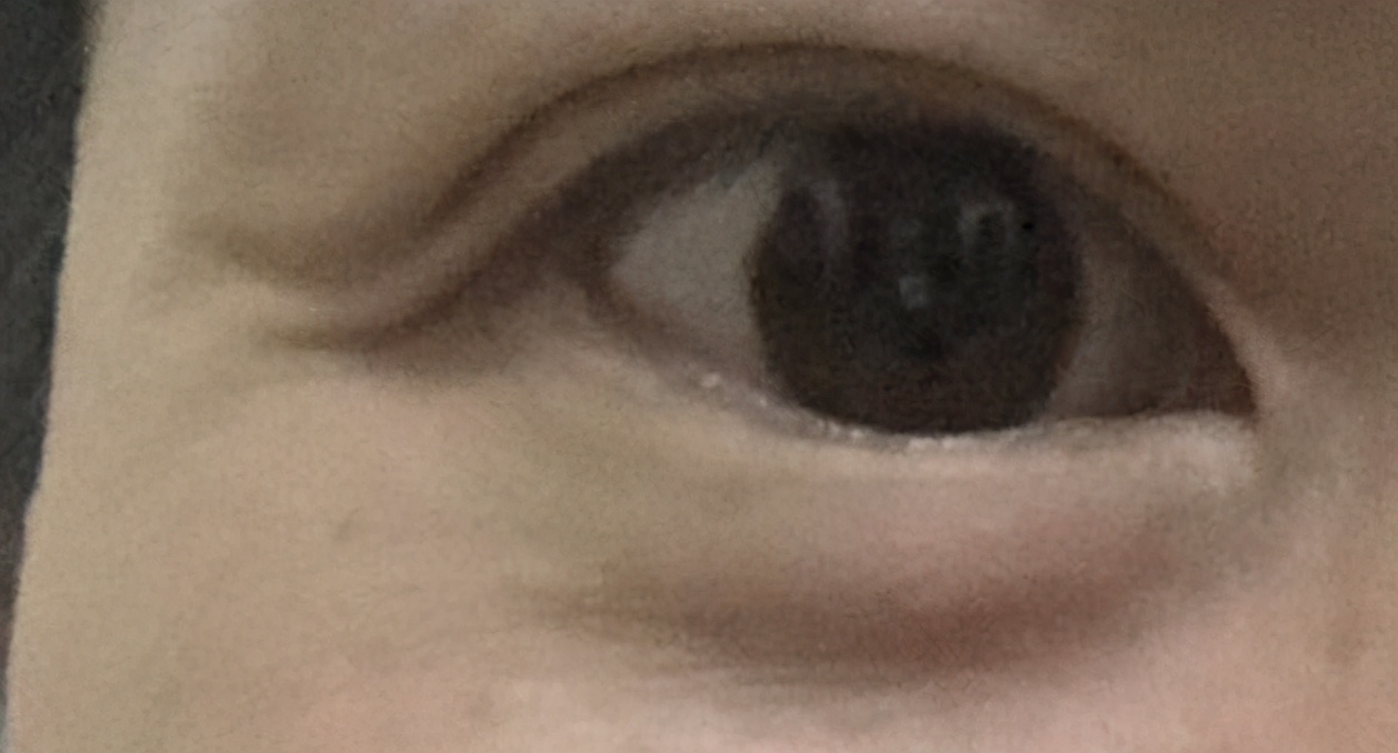 自己的双眼皮太深显老怎么修复,做的双眼皮一笑有皱纹怎么修复