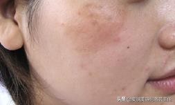 脸上有黑色素沉着斑怎能治好,脸上有色斑的护肤教程