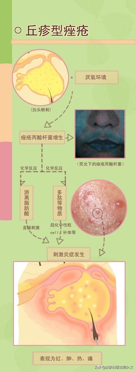 连续十年不停的长痘疮是怎么回事,身上长痘疮怎么治疗