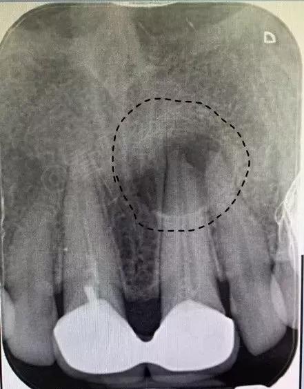 已经有牙洞了怎么根管治疗,牙髓腐烂坏死再做根管治疗会痛吗