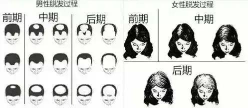 我才二十岁就秃头了该怎么办,我才20岁头发就要秃了