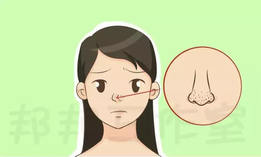 白头黑头粉刺怎么消除,长黑头粉刺的正确消除方法