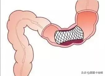 肚子胀不消化如何调理肠胃,肚子胀不知道饿怎么治疗