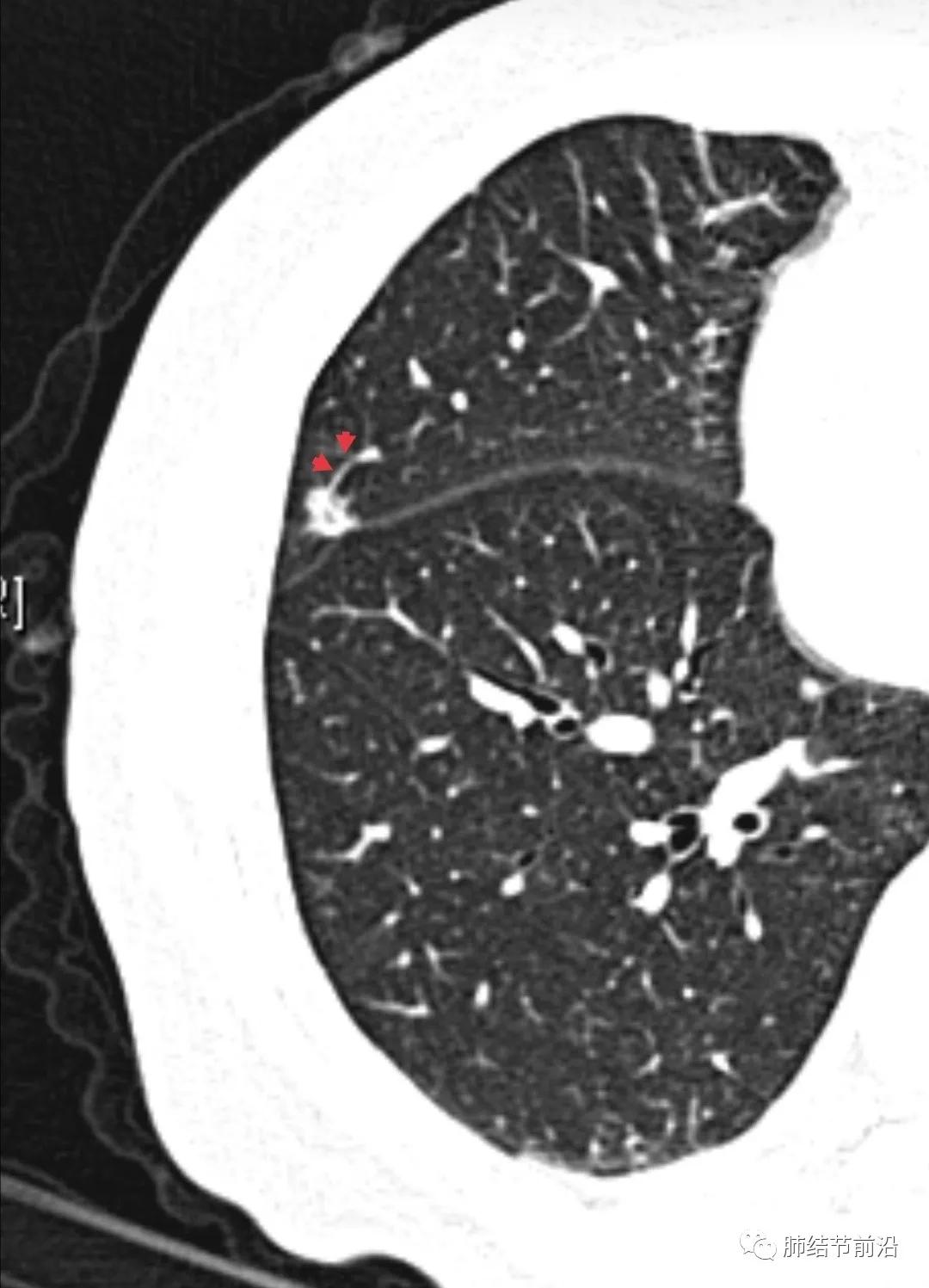 肺部ct肺结节读片教学视频,肺结节读片的专业术语