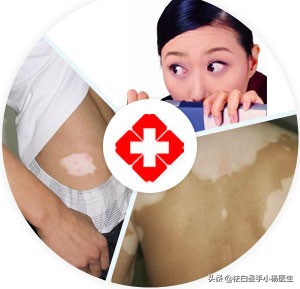 白癜风不稳定期怎么控制,发展期的白癜风在冬季还发展吗