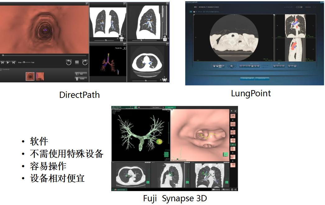 全球对肺癌治疗的最有效最新技术,肺癌的支气管镜介入治疗