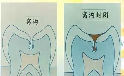 什么是儿童窝沟封闭?会不会痛?1分钟视频带你看懂#雅悦齿科#