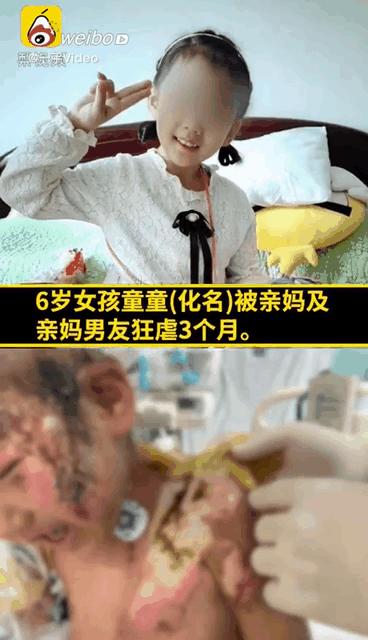 6岁女童被亲妈拔牙后续,6岁女童遭亲妈钳子拔牙热水浇头
