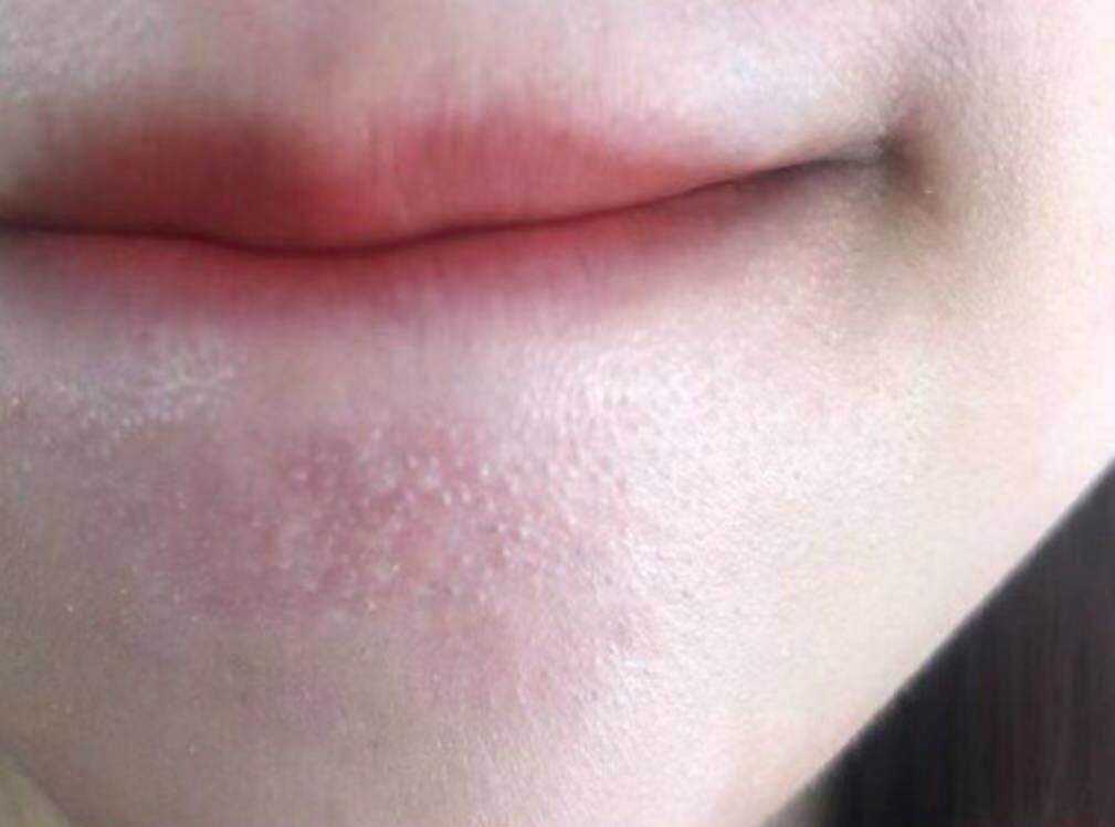 痘印痘坑消炎修复药膏,什么样的痘痘会留痘印痘坑