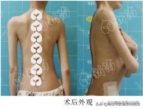广东脊柱侧弯女孩，一夜挺直腰杆，长高9厘米