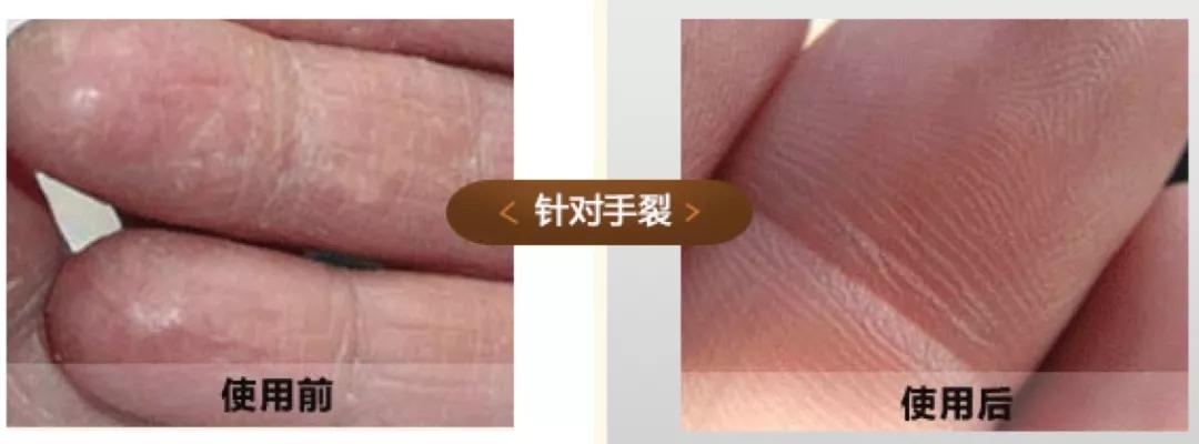 加拿大皲裂霜,加拿大修复膏