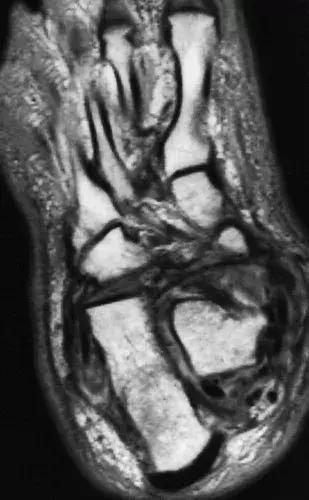 神经性骨关节病,神经性关节炎症状图片