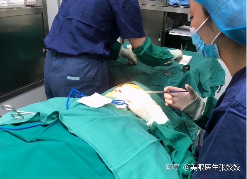 贴了双眼皮贴后的真实效果,贴双眼皮贴容易起翘