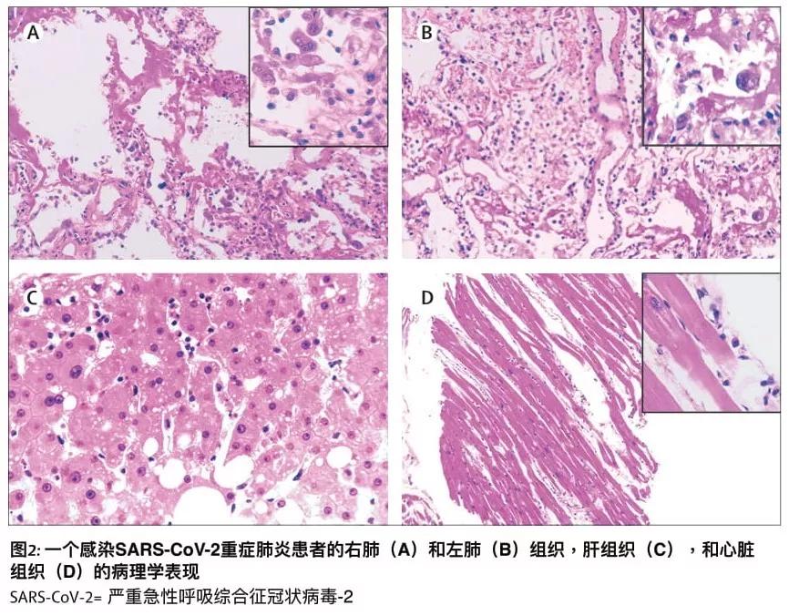 新冠肺炎病理报告视频,新冠病毒肺炎病理