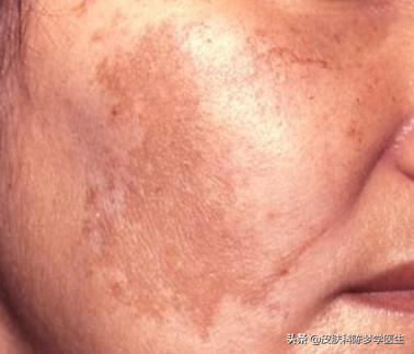 雀斑复发怎么治疗,雀斑怎么解决
