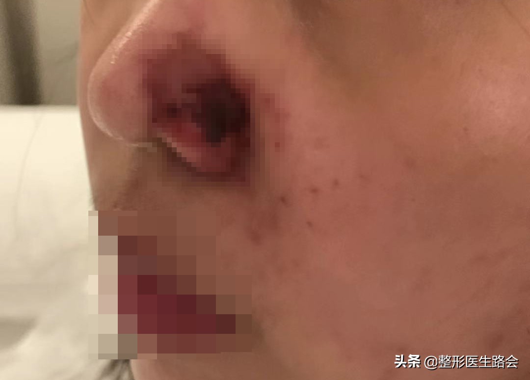 玻尿酸注射隆鼻可以热敷吗,玻尿酸注射鼻子有什么危害