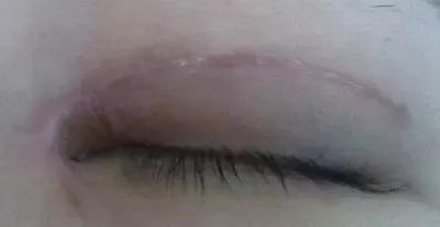 双眼皮修复为什么更贵,双眼皮修复是怎么做的