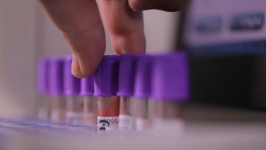 甲亢眼突最新治疗方法,甲亢突眼越来越严重的表现