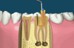根管治疗补牙是另外收费吗,根管治疗之后补牙齿一般要多少钱