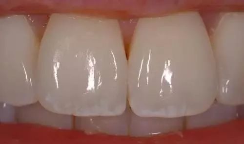 牙齿长白点到底是不是脱矿,牙齿出现白点该怎么办